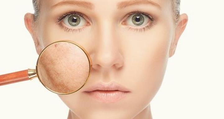 Mẹo vặt trị nám da mặt hiệu quả tận gốc