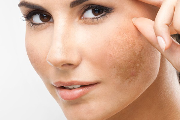Trị nám da mặt với công nghệ YAG LASER cải tiến 2018