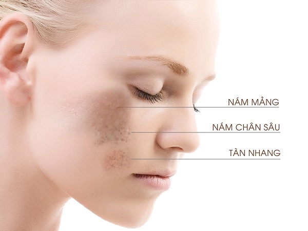 Các cách trị nám từ thiên nhiên siêu hiệu quả