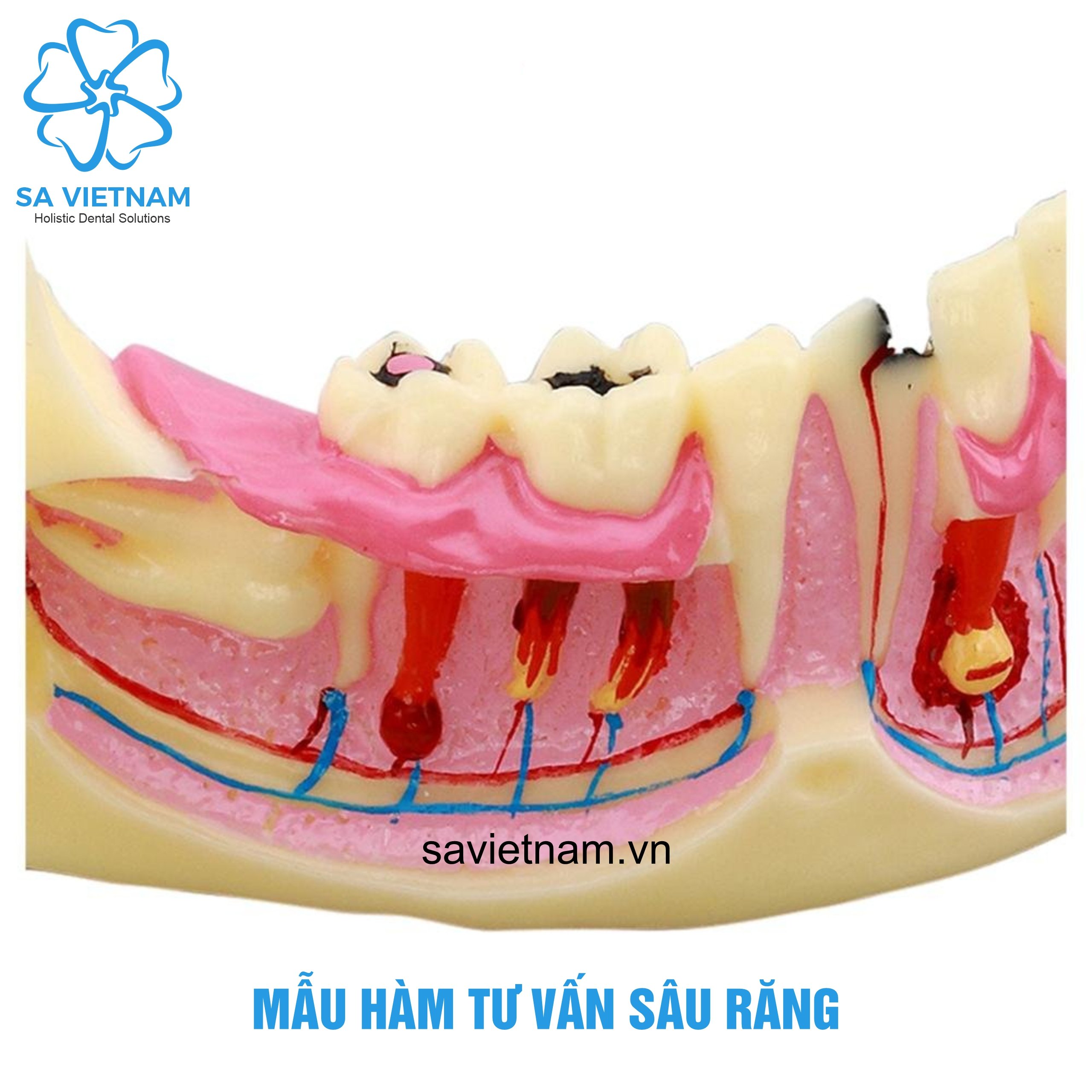 Mẫu tư vấn sâu răng