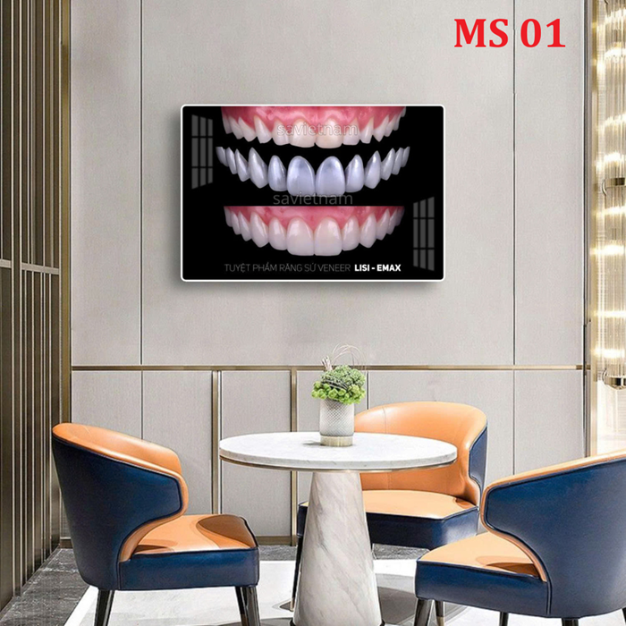 Tranh Veneer- Mặt dán sứ thẩm mỹ, Veneer Lisi, Veneer Emax