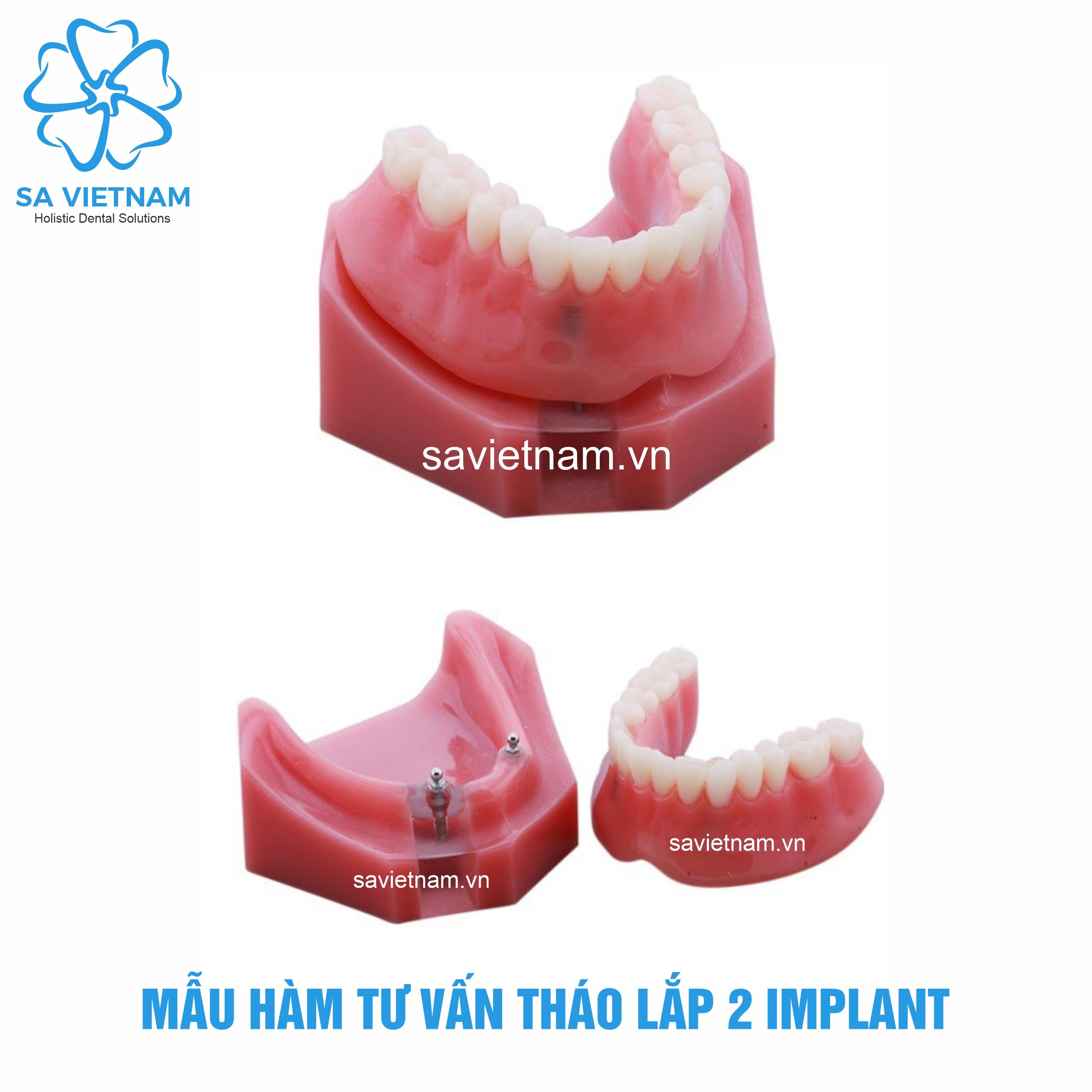 hàm tư vấn tháo lắp 2 implant