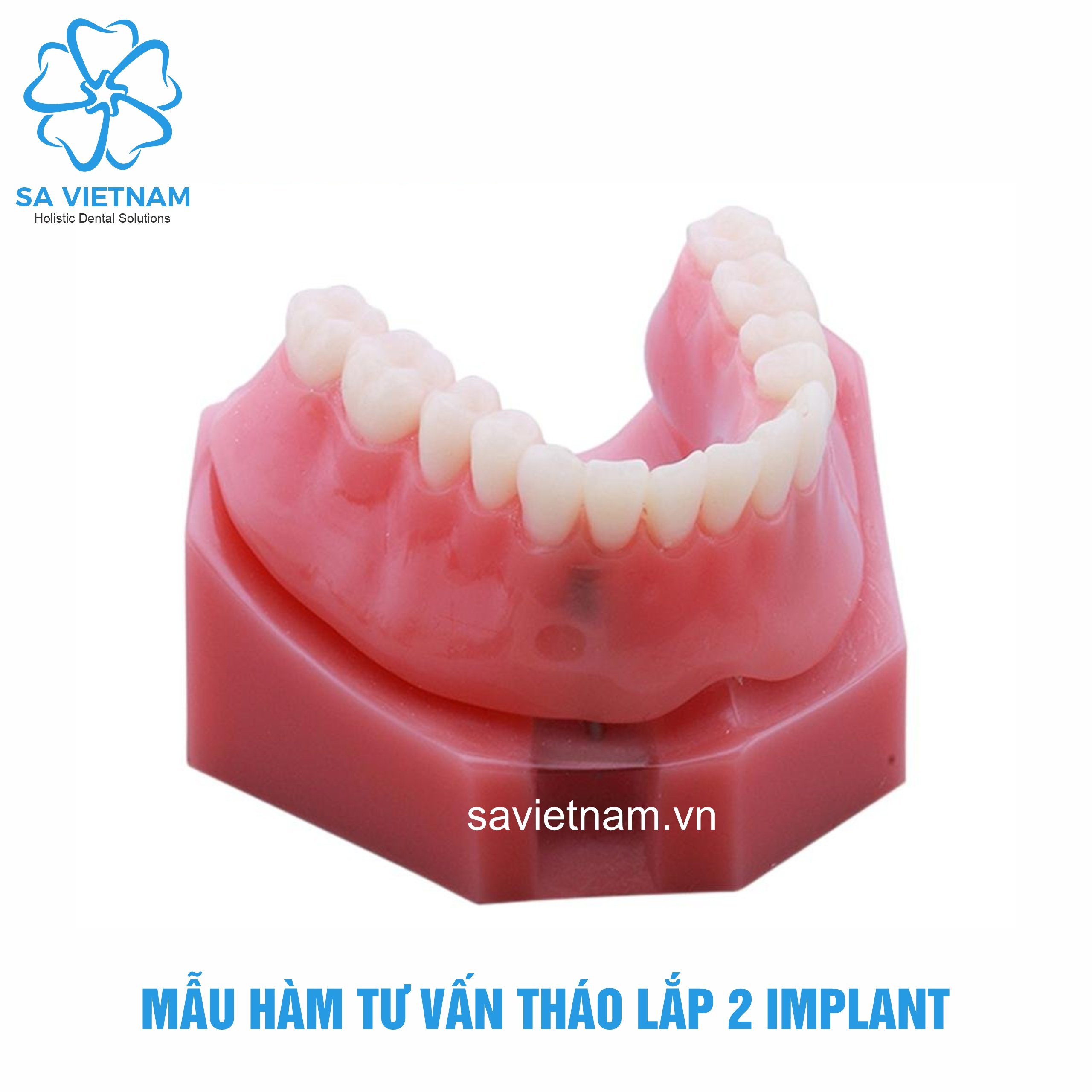 hàm tư vấn tháo lắp 2 implant