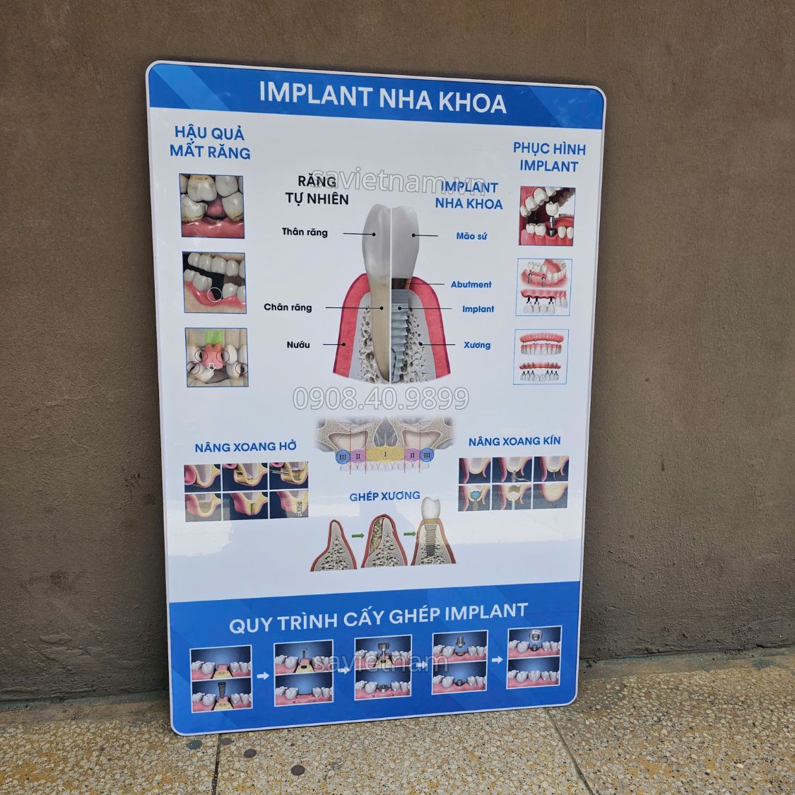 Tranh implant nha khoa