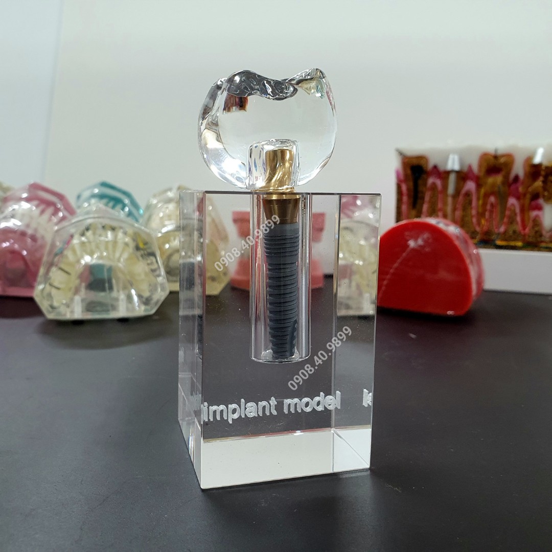Mô hình tư vấn implant pha lê
