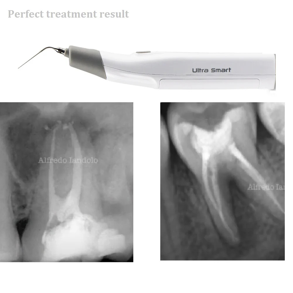 Máy Rung Rửa Nội Nha COXO Ultra Smart