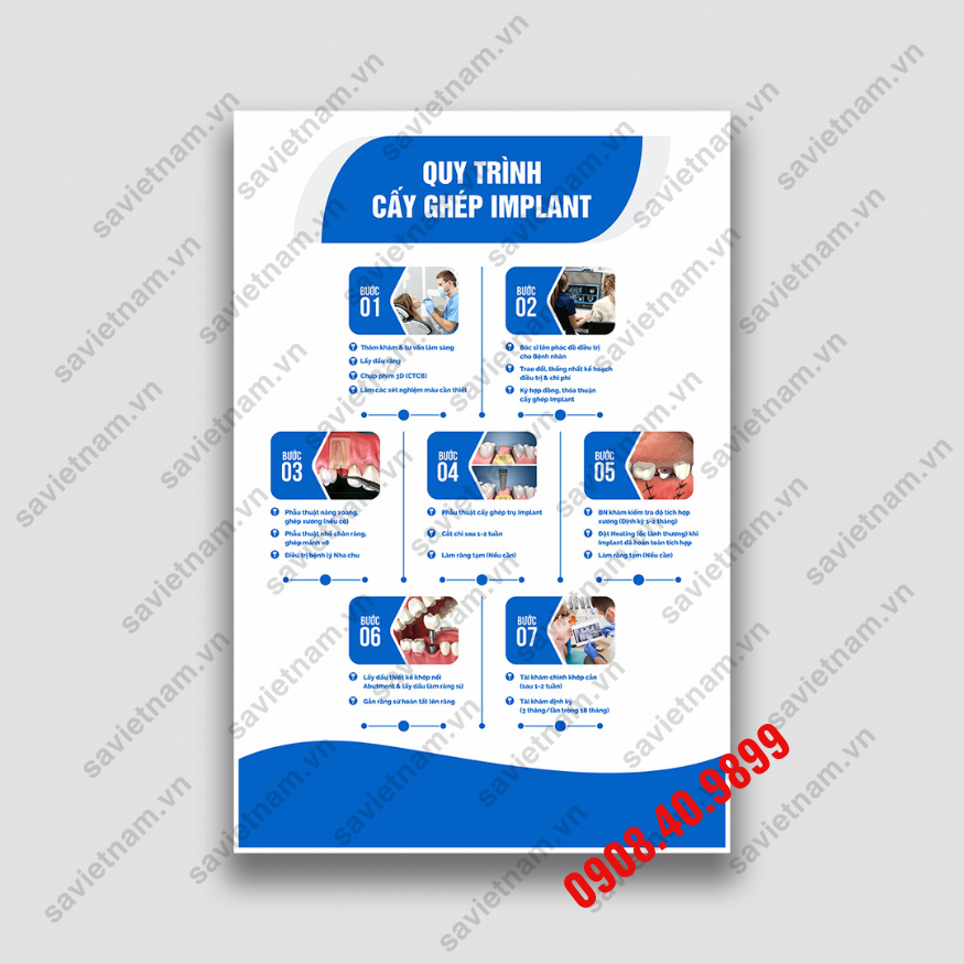 Tranh Quy trình cấy ghép implant nha khoa
