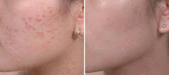 Những bước chăm sóc da bị mụn và tổn thương do kem trộn