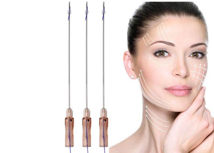 phương pháp căng da mặt chỉ vàng