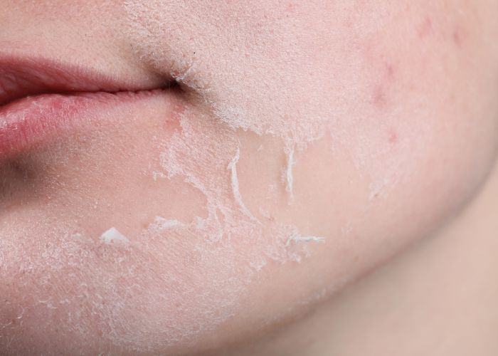 routine chăm sóc da mỏng yếu