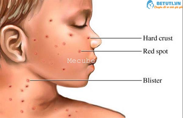 cham-soc-be-bi-thuy-dau