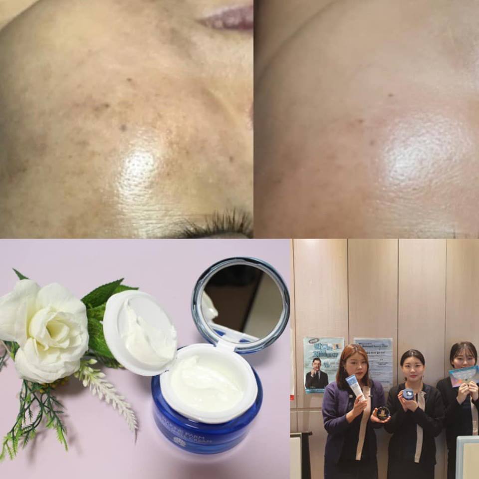 muốn trị nám và tàn nhang hiệu quả chúng ta cần những gì?