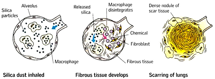 Hạt bụi nhựa là chất vô cùng độc hại Hạt bụi nhựa siêu nhỏ ảnh hưởng tới sức khỏe con người