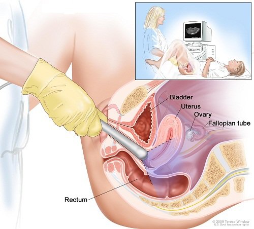 Siêu âm đầu dò có tác dụng gì?