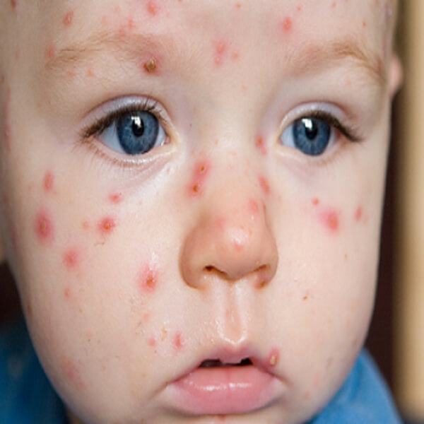 Các giai đoạn của bệnh chân tay miệng