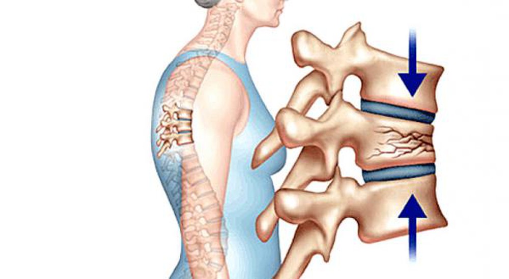 Các bệnh cơ xương khớp hay mắc phải ở người già