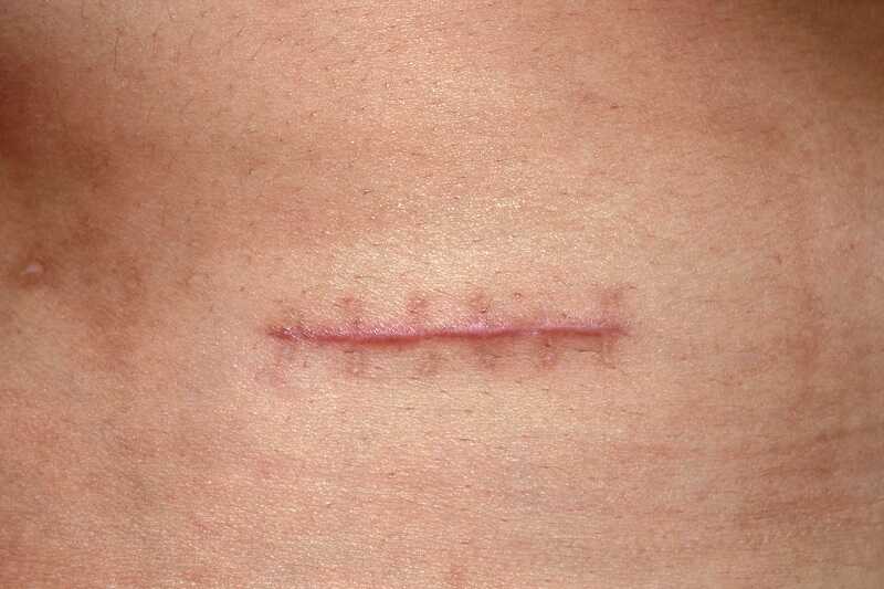 Viêm nang lông điều trị như thế nào