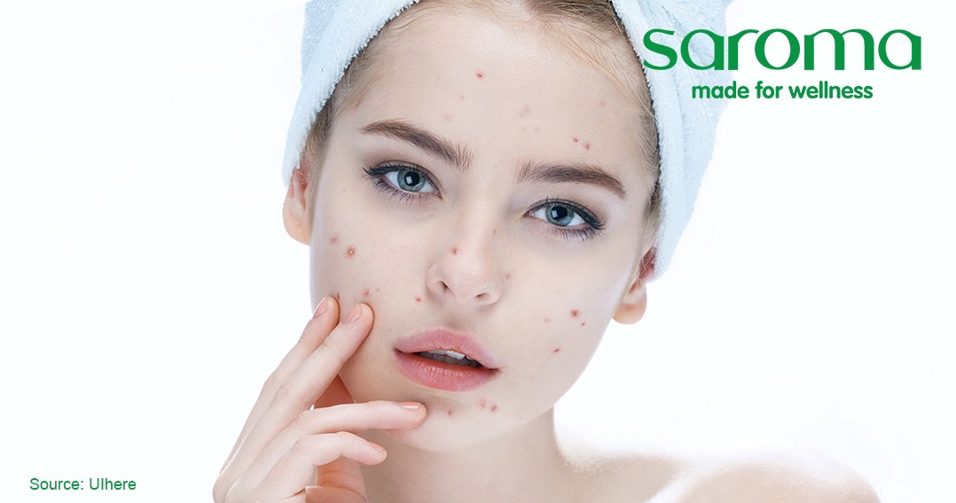 DẦU MASSAGE MẶT CÚC TRẮNG LA MÃ SAROMA – TẠM BIỆT NỖI LO MỤN KÉO DÀI DẦU MASSAGE MẶT CÚC TRẮNG LA MÃ SAROMA – TẠM BIỆT NỖI LO MỤN KÉO DÀI