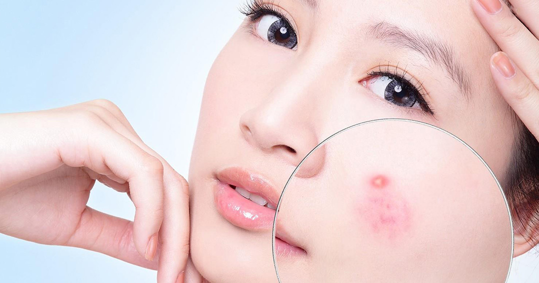 TẠM BIỆT MỤN VỚI TINH DẦU TRÀM TRÀ TẠM BIỆT MỤN VỚI TINH DẦU TRÀM TRÀ