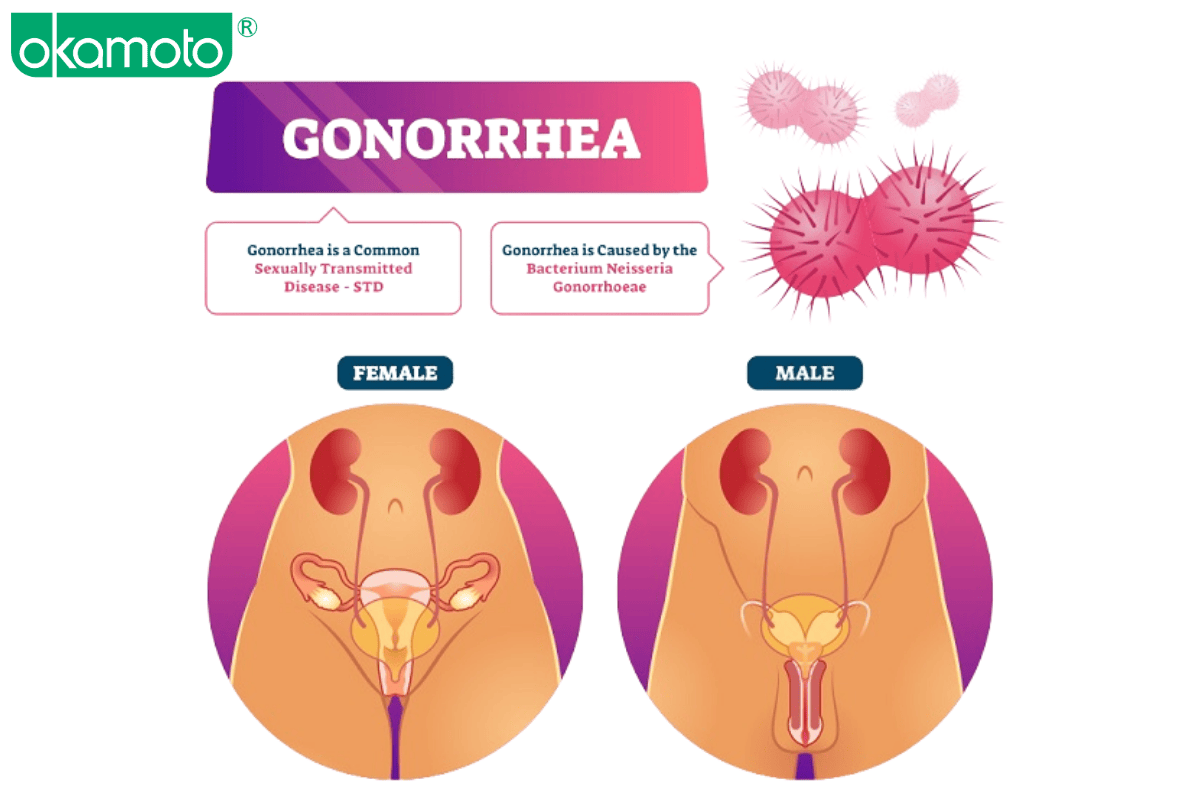 trieu chung lau va chlamydia o quan he dong gioi