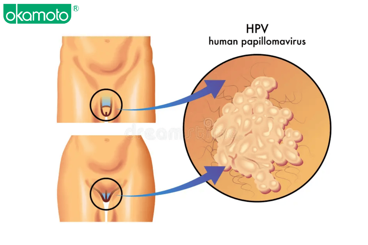 virus HPV va nguy co lay nhiem khi quan he dong gioi