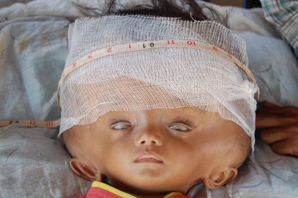 Bé chiến đấu cho cuộc sống sau khi bị phát triển tràn lan của người đứng đầu Bebê luta pela vida após sofrer crescimento desenfreado da cabeça