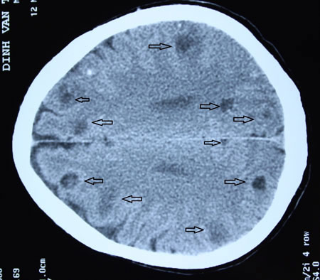 Các mũi tên chỉ các nang sán làm tổ trong não bệnh nhân 58 tuổi