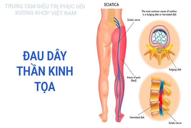 Bệnh đau dây thần kinh tọa