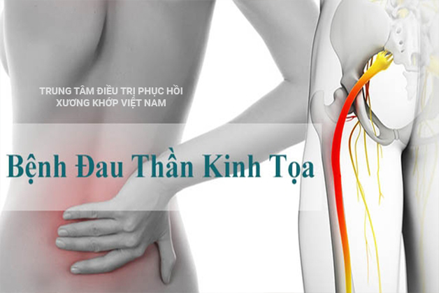 Bệnh đau thần kinh tọa