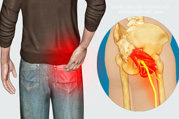 Bệnh đau Thần kinh tọa