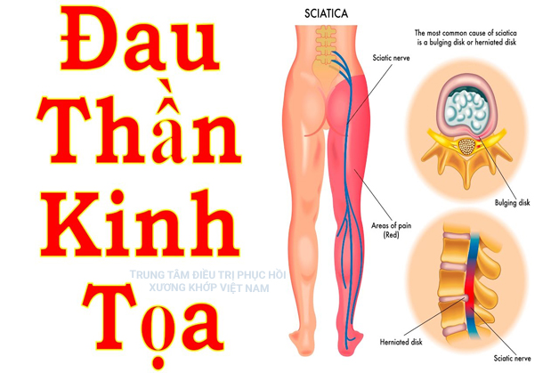 Bệnh đau Thần kinh tọa