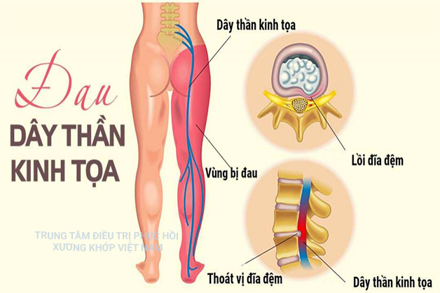 Bệnh đau Thần kinh tọa