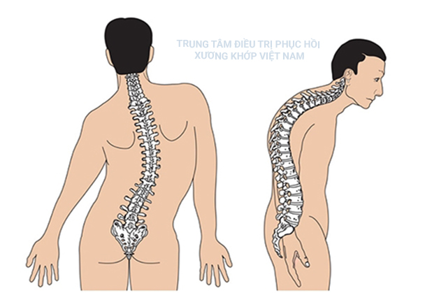 Bệnh Gai cột sống