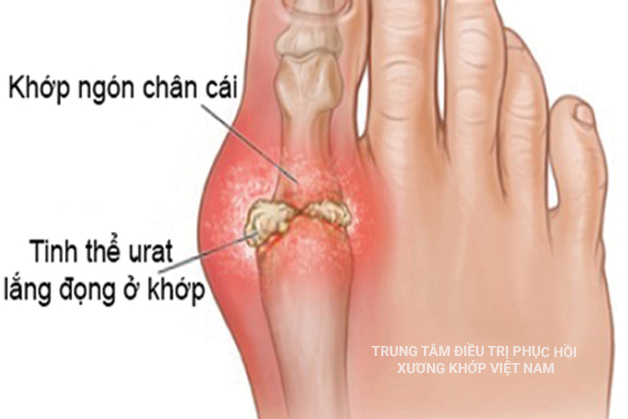 Bệnh Gout