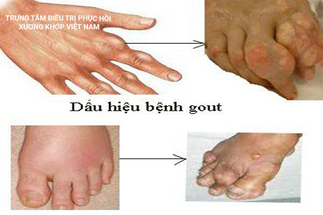 Bệnh Gout
