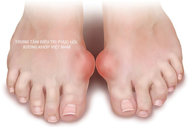 Bệnh Gout gây biến dạng khớp bàn chân