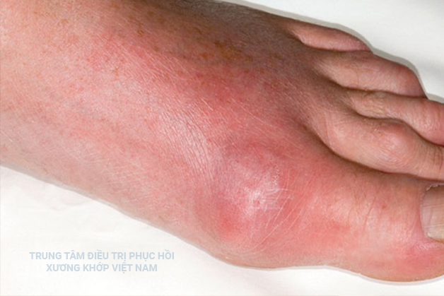 Bệnh khớp có sưng, nóng, đỏ