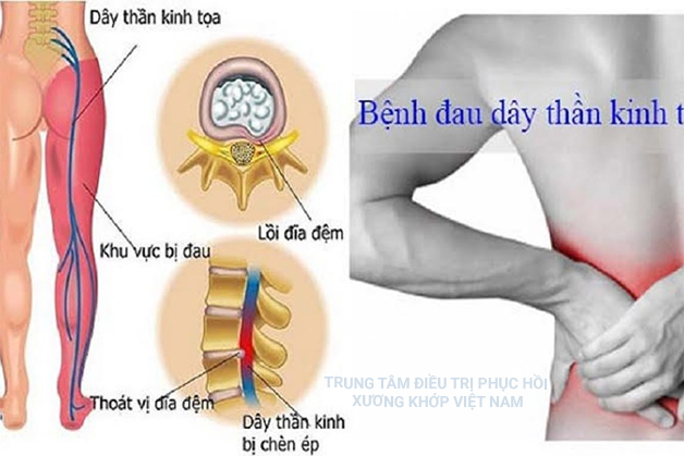 Bệnh thoát vị đĩa đệm