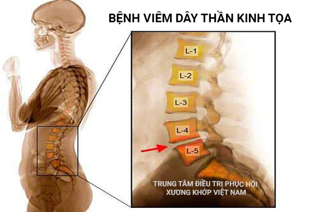 Bệnh viêm dây thần kinh