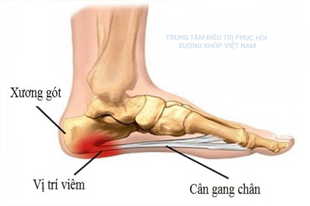 Bệnh viêm gân gan chân