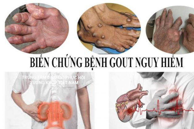 Biến chứng Bệnh Gout