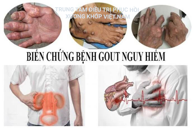 Biến chứng bệnh Gout nguy hiểm 