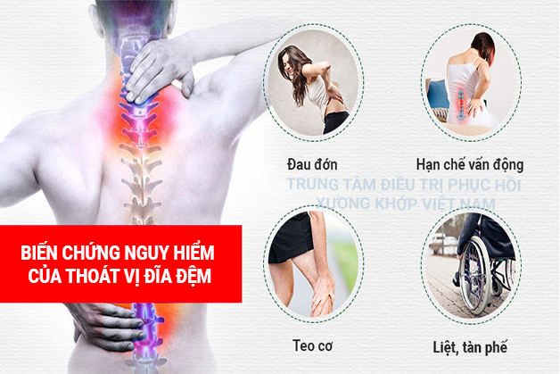 Biến chứng của bệnh Thoát vị đĩa đệm