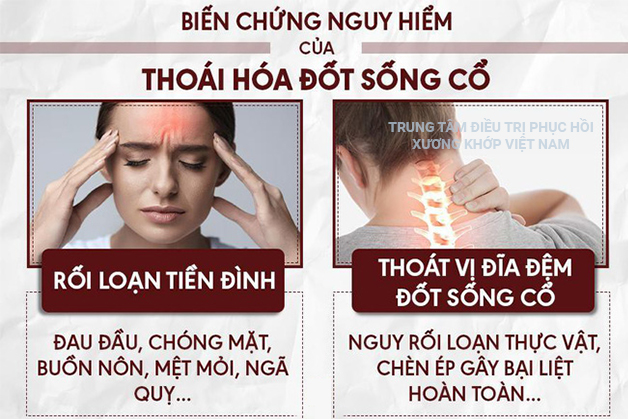 Biến chứng nguy hiểm của Thoái Hóa Cột Sống