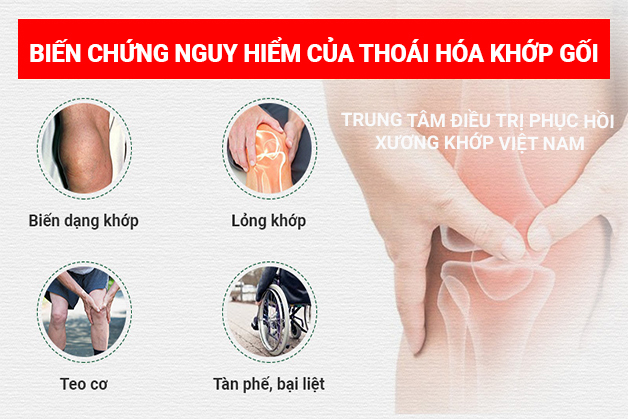 Biến chứng nguy hiểm của thoái hóa khớp gối