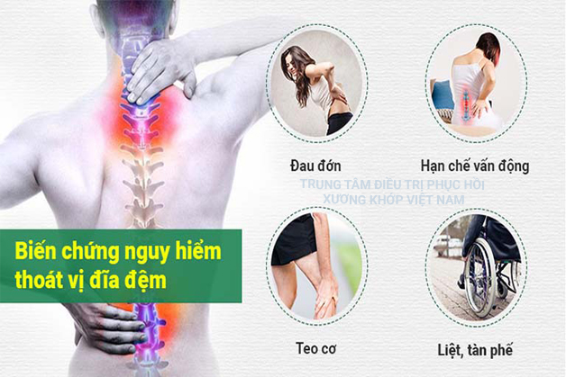 Biến chứng Thoát vị đĩa đệm