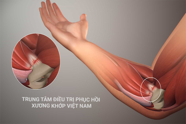 Biến chứng nguy hiểm về xương khớp như thoái hóa khớp, viêm khớp...