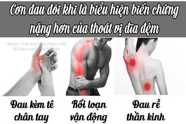  Biến chứng Thoát vị đĩa đệm