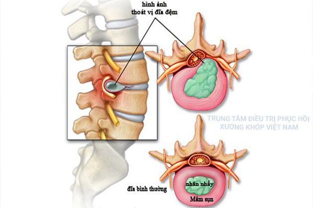 Biến chứng thoát vị đĩa đệm