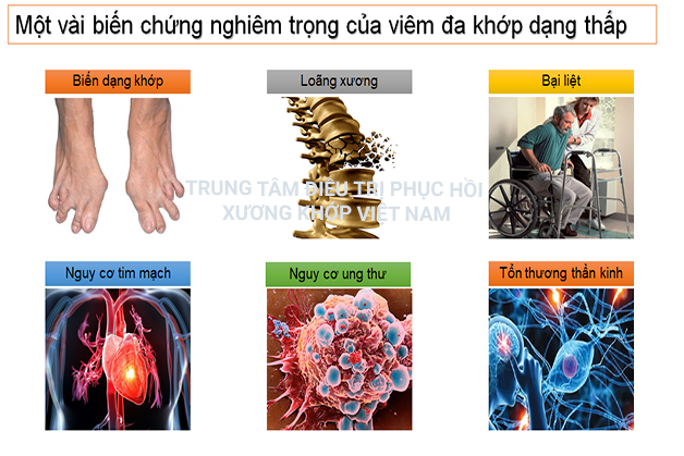 Biến chứng viêm đa khớp dạng thấp